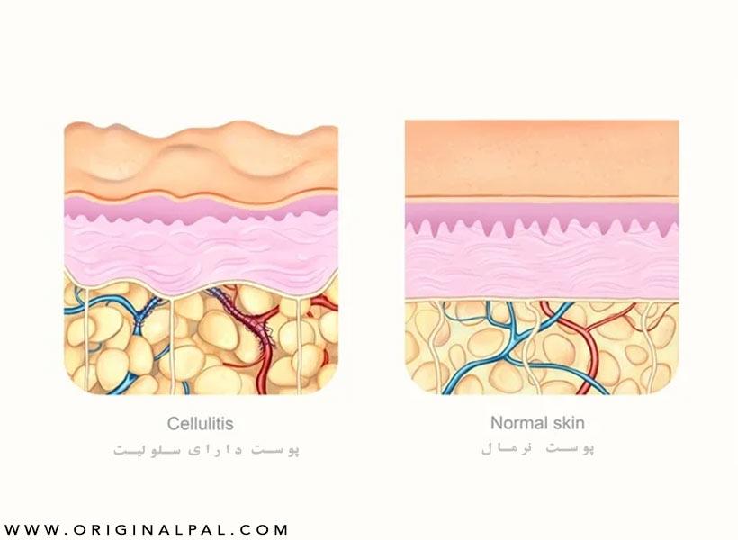 پوست نرمال و پوست دارای سلولیت