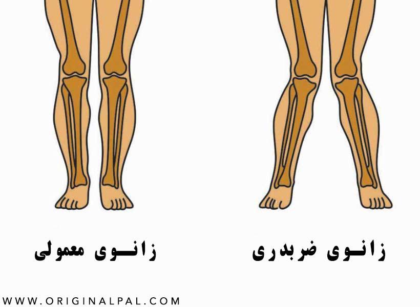 تشخیص زانوی ضربدری